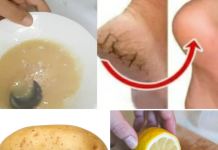 Natural Remedy for Cracked Heels: The Potato and Lemon Foot Mask