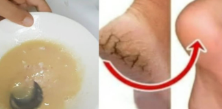 Natural Remedy for Cracked Heels: The Potato and Lemon Foot Mask