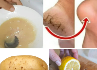 Natural Remedy for Cracked Heels: The Potato and Lemon Foot Mask