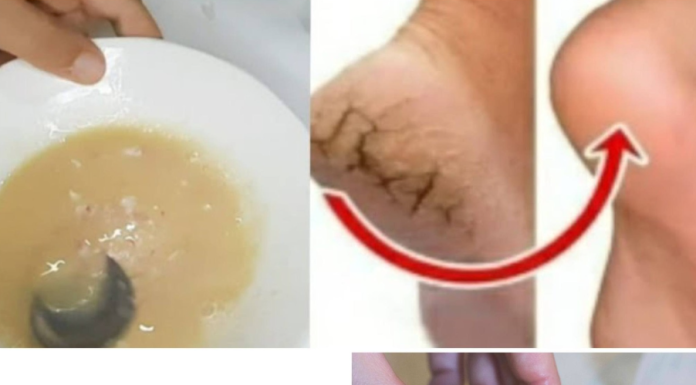 Natural Remedy for Cracked Heels: The Potato and Lemon Foot Mask