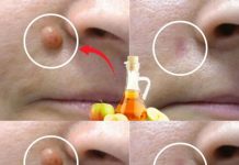 APPLE VINEGAR Removes WARTS in 24 HOURS! Just Do This…