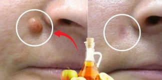 APPLE VINEGAR Removes WARTS in 24 HOURS! Just Do This…