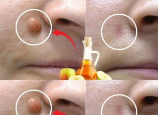 APPLE VINEGAR Removes WARTS in 24 HOURS! Just Do This…