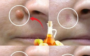 APPLE VINEGAR Removes WARTS in 24 HOURS! Just Do This…