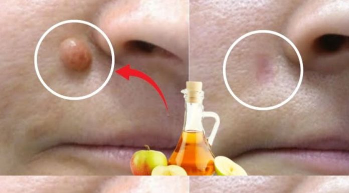 APPLE VINEGAR Removes WARTS in 24 HOURS! Just Do This…