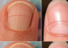 If You Don’t Have A Half Moon Shape On Your Nails, Visit A DOCTOR Immediately