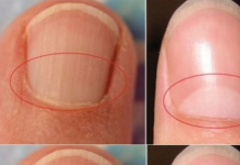 If You Don’t Have A Half Moon Shape On Your Nails, Visit A DOCTOR Immediately