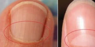 If You Don’t Have A Half Moon Shape On Your Nails, Visit A DOCTOR Immediately