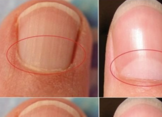 If You Don’t Have A Half Moon Shape On Your Nails, Visit A DOCTOR Immediately