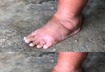 The Most Important Vitamin for Removing Swelling of Hands, Legs, and Feet