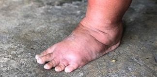 The Most Important Vitamin for Removing Swelling of Hands, Legs, and Feet