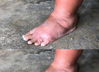 The Most Important Vitamin for Removing Swelling of Hands, Legs, and Feet