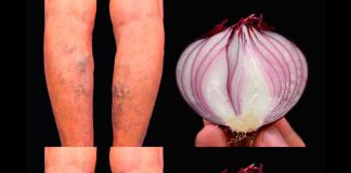 Top 3 Natural Remedies for Varicose Veins