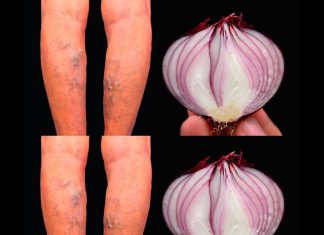 Top 3 Natural Remedies for Varicose Veins