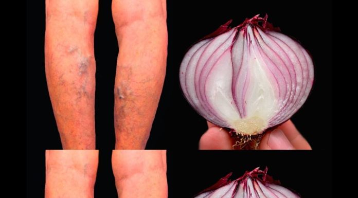 Top 3 Natural Remedies for Varicose Veins