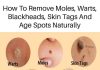 Home cures for a variety of skin conditions, including age spots, moles, blackheads, warts, and skin tags