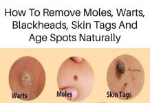 Home cures for a variety of skin conditions, including age spots, moles, blackheads, warts, and skin tags