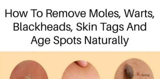 Home cures for a variety of skin conditions, including age spots, moles, blackheads, warts, and skin tags