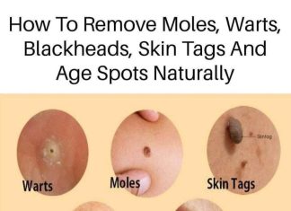 Home cures for a variety of skin conditions, including age spots, moles, blackheads, warts, and skin tags
