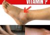 No.1 Vitamin for Removing Leg and Foot Swelling!