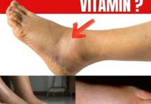No.1 Vitamin for Removing Leg and Foot Swelling!