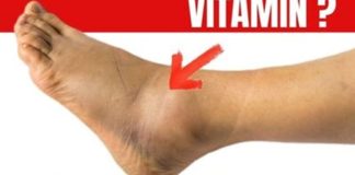 No.1 Vitamin for Removing Leg and Foot Swelling!