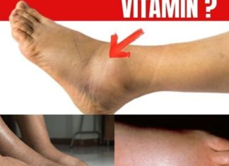 No.1 Vitamin for Removing Leg and Foot Swelling!