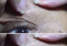 Effective Skin Tag Removal with Apple Cider Vinegar: A Natural Solution