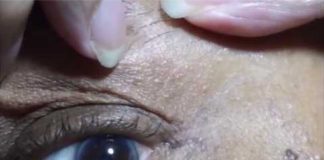 Effective Skin Tag Removal with Apple Cider Vinegar: A Natural Solution