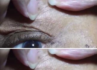 Effective Skin Tag Removal with Apple Cider Vinegar: A Natural Solution