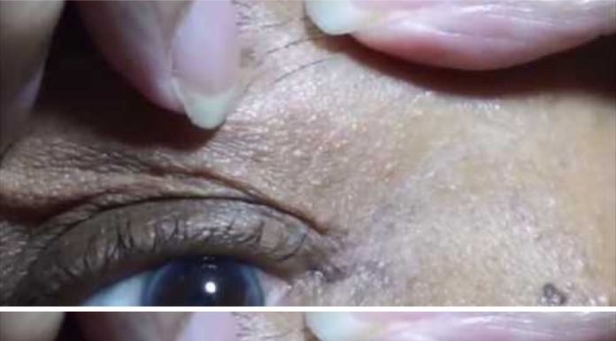 Effective Skin Tag Removal with Apple Cider Vinegar: A Natural Solution