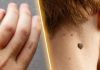 How to Remove Skin Tags and Warts Overnight: Safe and Effective Methods