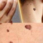 How to Remove Skin Tags and Warts Overnight: Safe and Effective Methods