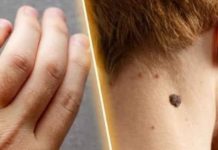 How to Remove Skin Tags and Warts Overnight: Safe and Effective Methods