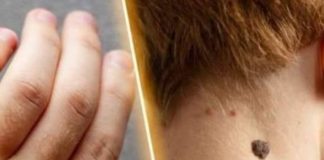 How to Remove Skin Tags and Warts Overnight: Safe and Effective Methods