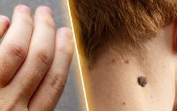 How to Remove Skin Tags and Warts Overnight: Safe and Effective Methods