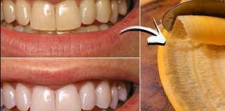 The Hidden Dental Secret: How Banana Peels Can Remove Tartar and Whiten Teeth in Just 2 Minutes!