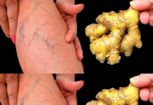 Natural Remedies for Varicose Veins: Simple Solutions for Healthier Legs.