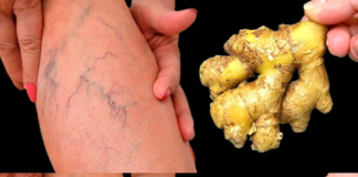 Natural Remedies for Varicose Veins: Simple Solutions for Healthier Legs.