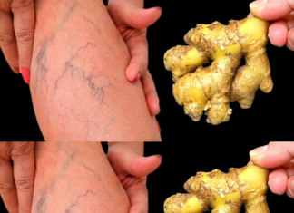 Natural Remedies for Varicose Veins: Simple Solutions for Healthier Legs.