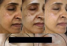 This Vitamin Removes Age Spots Permanently (ALWAYS Works)
