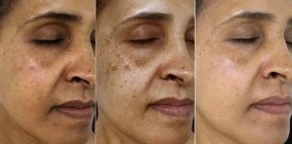 This Vitamin Removes Age Spots Permanently (ALWAYS Works)
