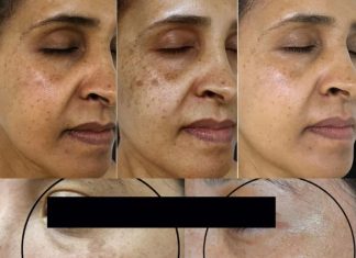 This Vitamin Removes Age Spots Permanently (ALWAYS Works)