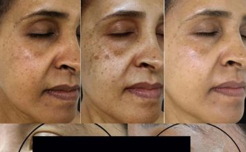 This Vitamin Removes Age Spots Permanently (ALWAYS Works)
