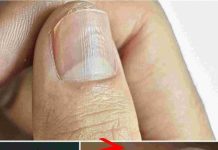 Understanding Why You Have Lines on Your Nails