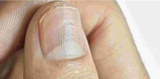 Understanding Why You Have Lines on Your Nails