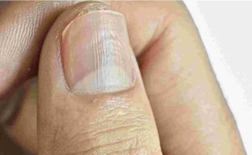 Understanding Why You Have Lines on Your Nails