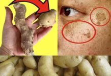 Shocking: She Wiped the Dark Spots Off Her Face with Potatoes and Ginger in Just 20 Minutes