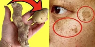 Shocking: She Wiped the Dark Spots Off Her Face with Potatoes and Ginger in Just 20 Minutes