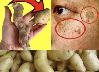 Shocking: She Wiped the Dark Spots Off Her Face with Potatoes and Ginger in Just 20 Minutes